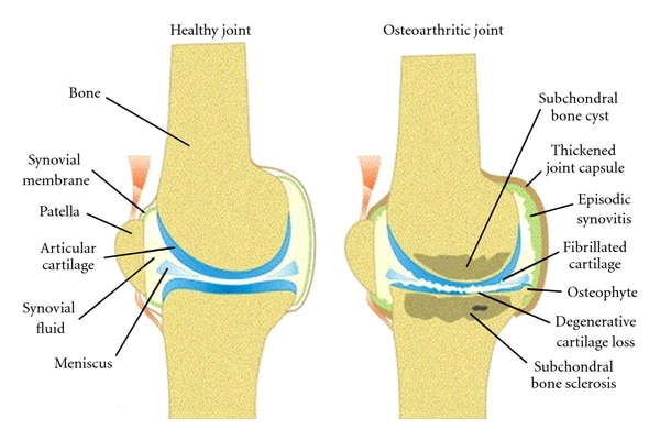 osteoarthritis b