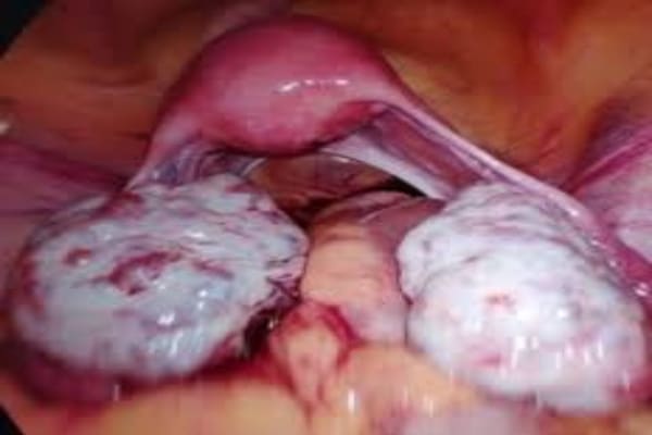 pcos