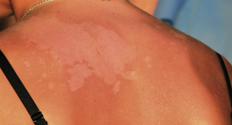 Υπεριώδης Ακτινοβολία: Τι είναι το ηλιακό έγκαυμα;