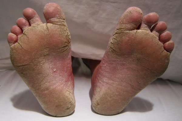 allergia