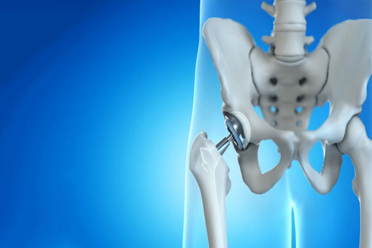 Αντικατάσταση συνδέσμων: Μύθοι και αλήθειες που αφορούν την αντικατάσταση αρθρώσεων