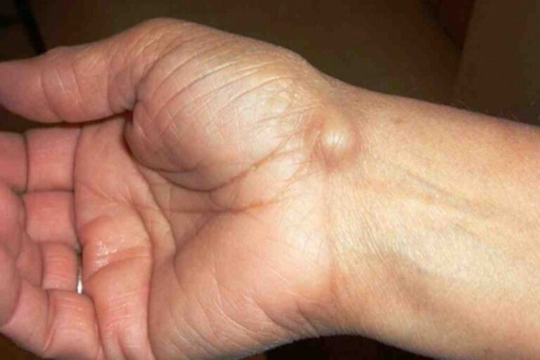 Γάγγλιο δέρμα: Αποκωδικοποίηση και αιτίες των σκληρών εξογκωμάτων κάτω από το δέρμα