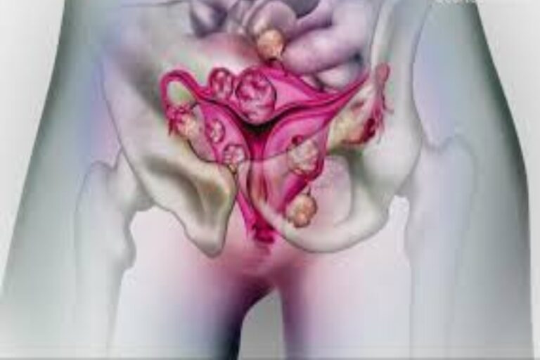 Ινομυώματα μήτρας: Αύξηση 50% στα ινομυώματα μήτρας σε γυναίκες 30 ετών και άνω