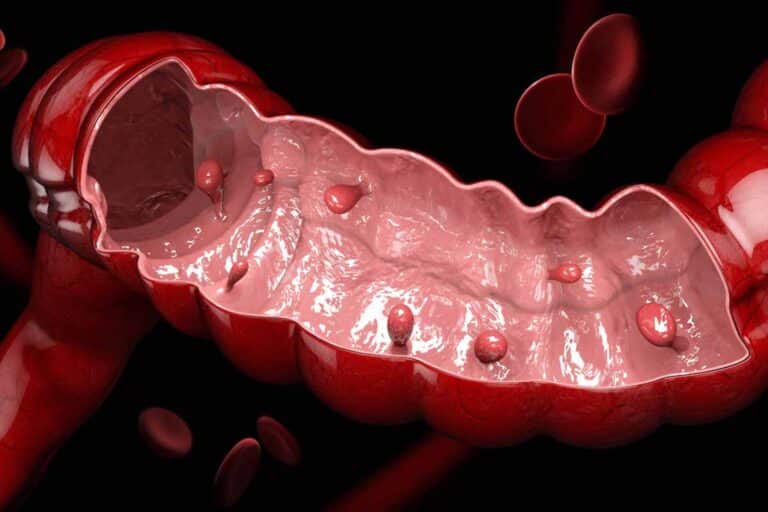 Πολύποδες: Εξερεύνηση των τύπων πολύποδα, των αιτιών και των θεραπειών τους