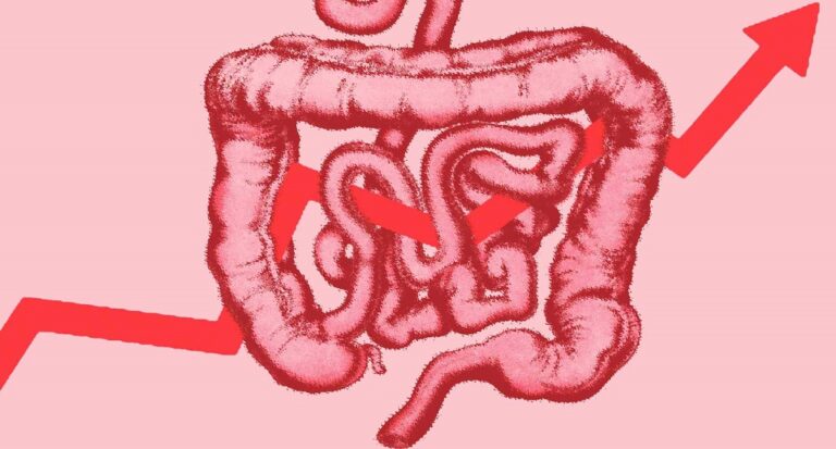 Καρκίνος του Παχέος Εντέρου: Δεν έχουν λάβει σύσταση κλινικού ιατρού όσοι έχουν καθυστερήσει τον προληπτικό έλεγχο