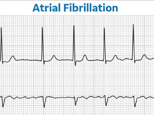 afib e1695146367113