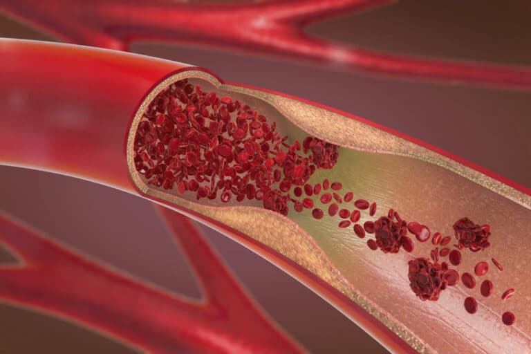 Αθηροσκλήρωση: Τι είναι η αθηροσκλήρωση και πώς επηρεάζει την καθημερινότητά μας;