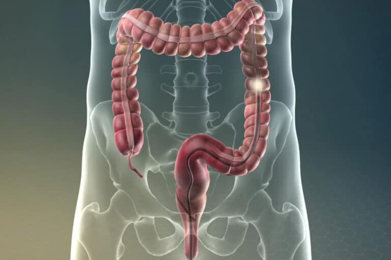 Παχύ έντερο: Ποιες εναλλακτικές θεραπείες για την προστασία του εντέρου;