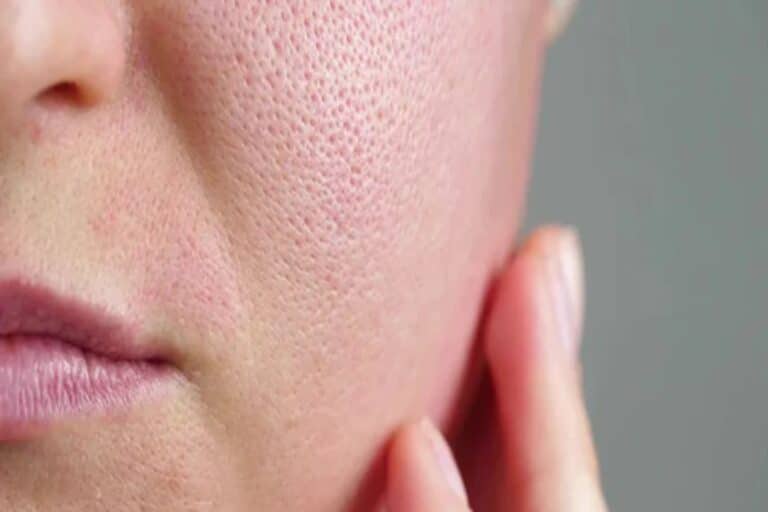 Πόροι δέρματος: Σπιτικές θεραπείες για να θεραπεύσετε τους ανοιχτούς πόρους του δέρματός σας