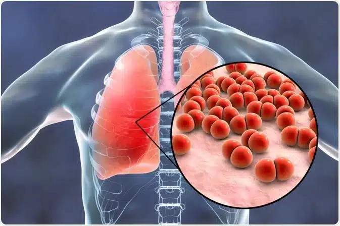 ai pneumonia