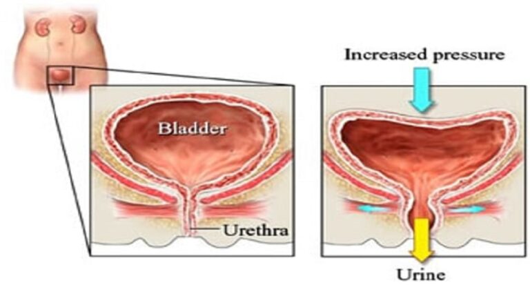 Ακράτεια Ούρων: Μην υποβιβάζετε το πρόβλημα – Αντιμετωπίστε το