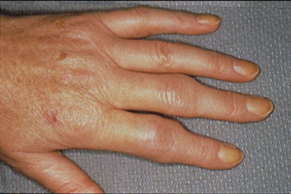 arthritida 10