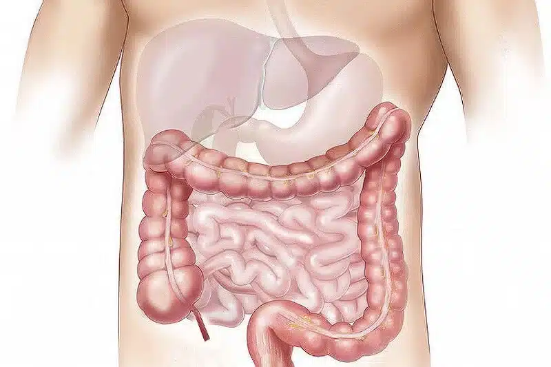 crohn b