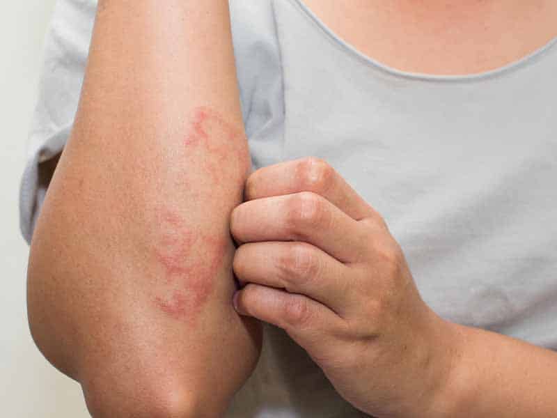 eczema