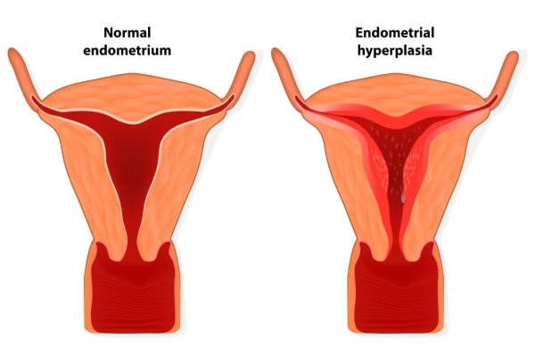 endomitrio 2