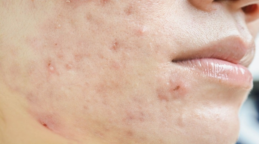 acne