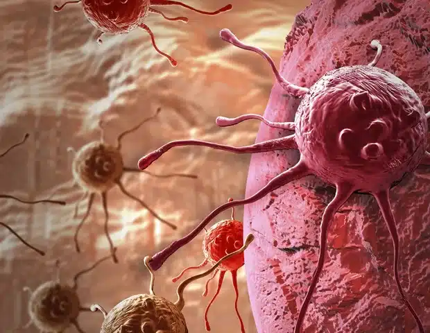 cancer