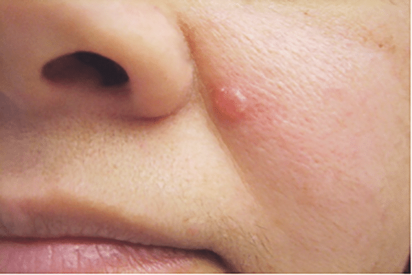 karkinoma