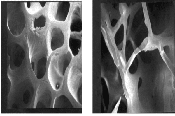 osteoporosis