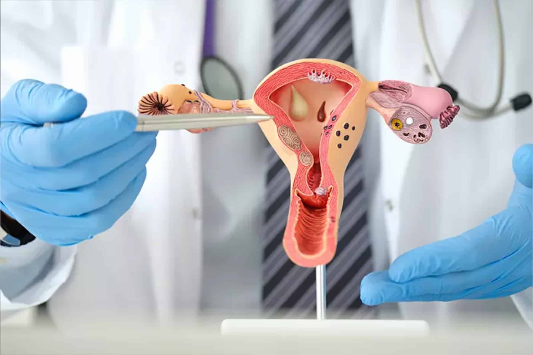 pcos 3