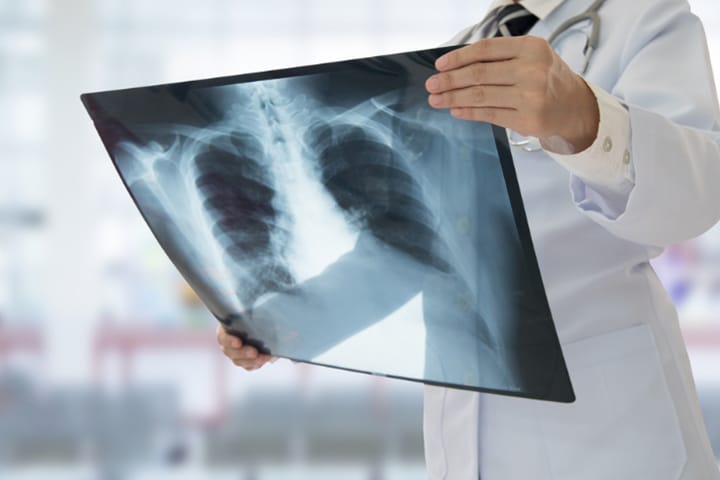 pneumonia