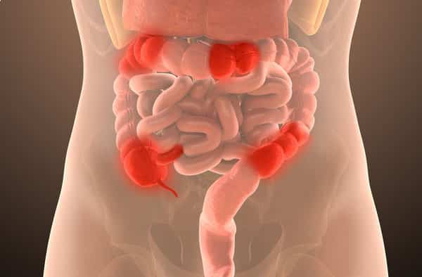 crohns disease