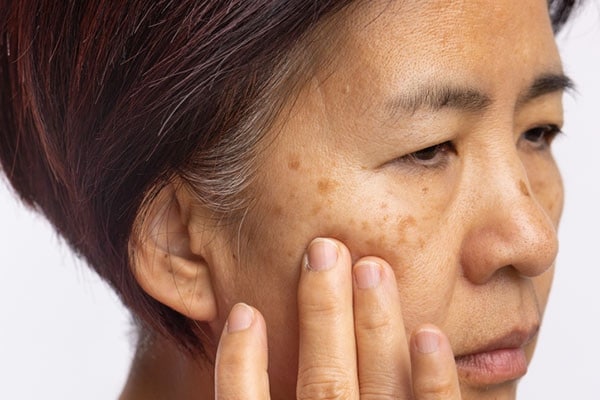 melasma 2