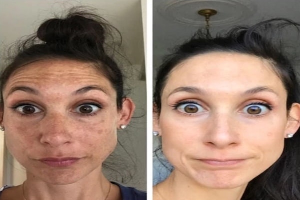 melasma