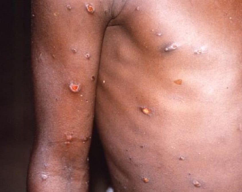 mpox on arms chest cdc