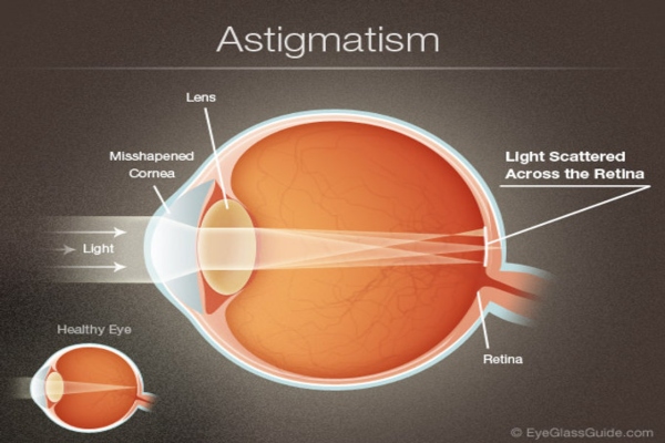 astigmatismos 1
