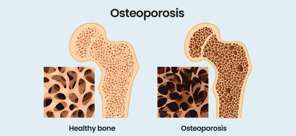 Osteoporosis a