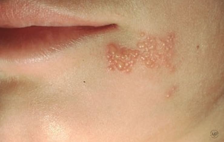 herpes a