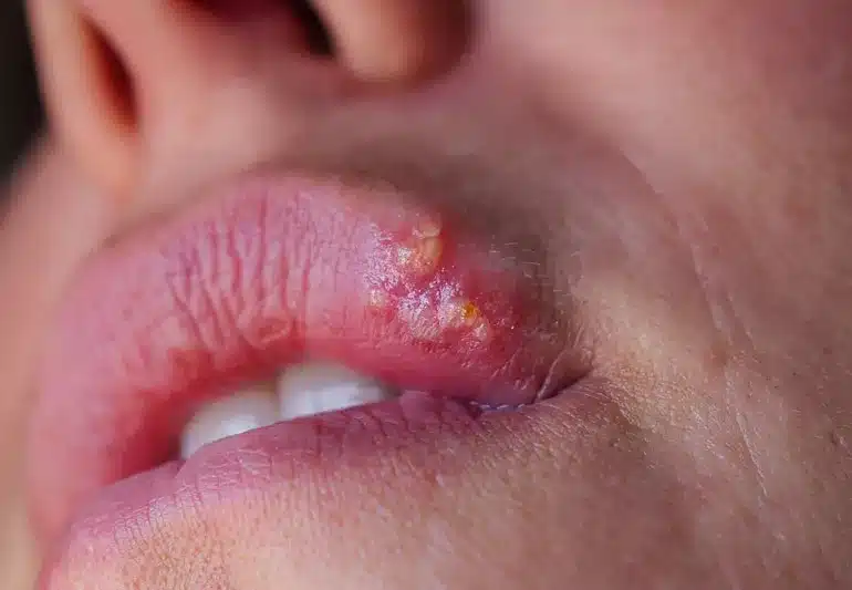 herpes c