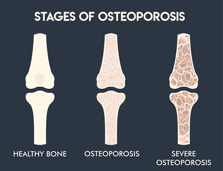 osteoperosis stages