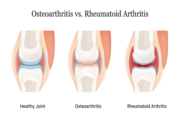 arthritis