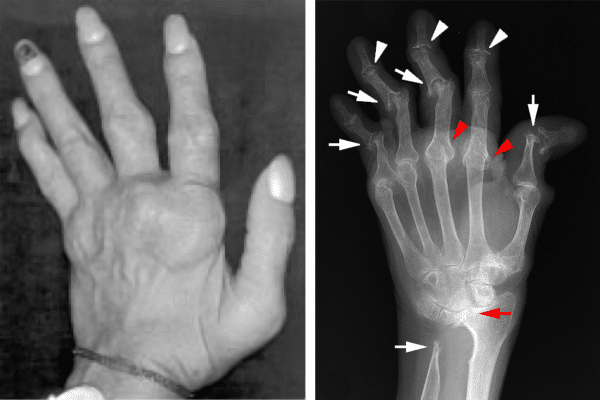 arthritis1