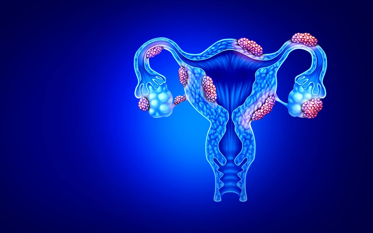 endomitriosi diagnosi