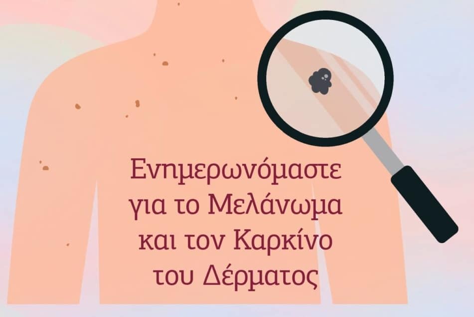 melanoma 1