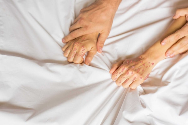 psoriasi2