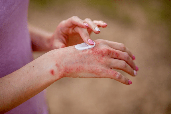 psoriasi2