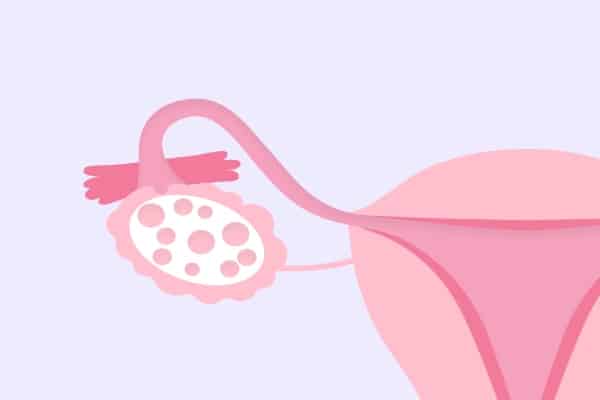 pcos2 ready