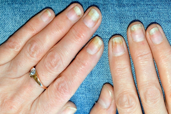 psoriasiki2