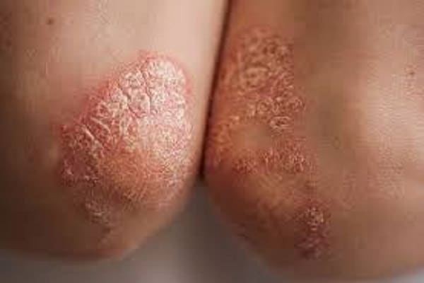 psoriasis 1