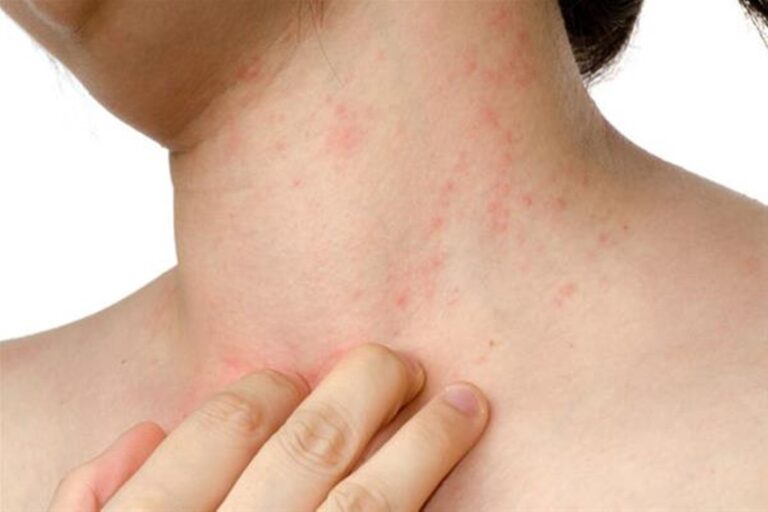 Ψωρίαση: Τα ποσοστά αυξάνονται παγκοσμίως με έμφαση στις πλουσιότερες περιοχές.