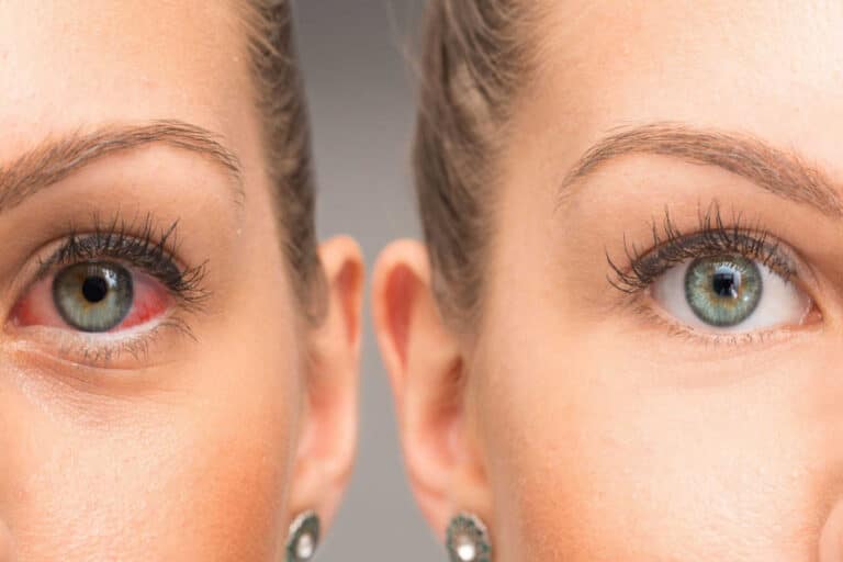 Γλαύκωμα: Ο ύπνος χωρίς μαξιλάρι μπορεί να μειώσει την πίεση των ματιών