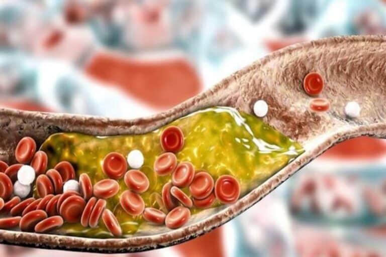 Δυσλιπιδαιμία μετά τα 40: Πότε είναι τρόπος ζωής και πότε κληρονομικότητα