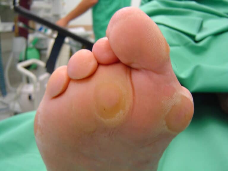 Κότσι: Οι αιτίες που το προκαλούν και οι θεραπευτικές επιλογές