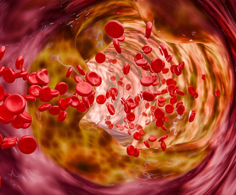 Περιφερική αρτηριοπάθεια: Διάγνωση και σύγχρονες θεραπευτικές επιλογές