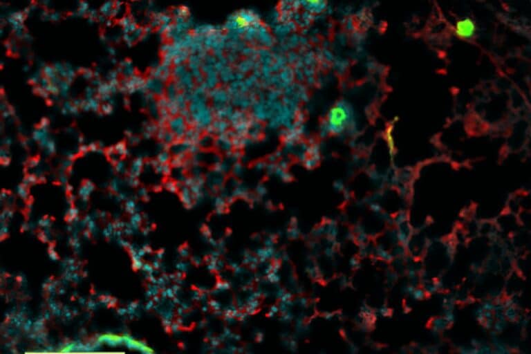 Υπέρηχος: Νέο εργαλείο απεικόνισης μειώνει τις περιττές βιοψίες μαστού