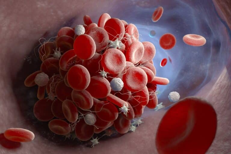 Θρόμβωση: 7 σημάδια που μπορεί να σου δείχνει το σώμα και δεν πρέπει να τα αγνοήσεις